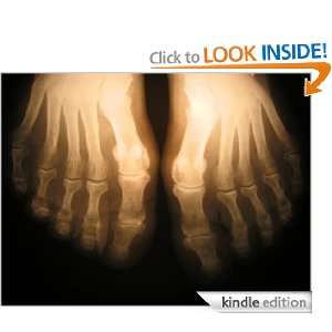 Understanding Arthritis And Quickly Applying Its Treatments Jason 