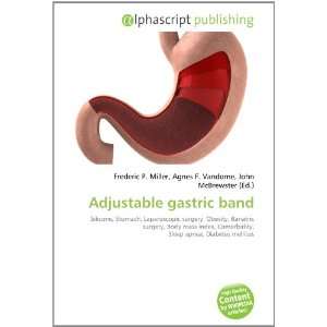  Adjustable gastric band (9786133824645) Books